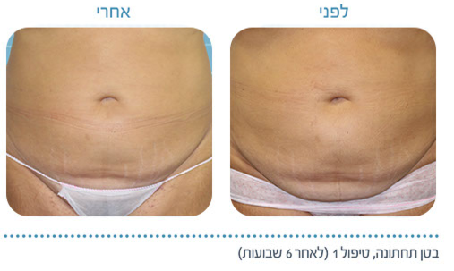 תמונה לכתבה, לפני ואחרי טיפול בטן תחתונה