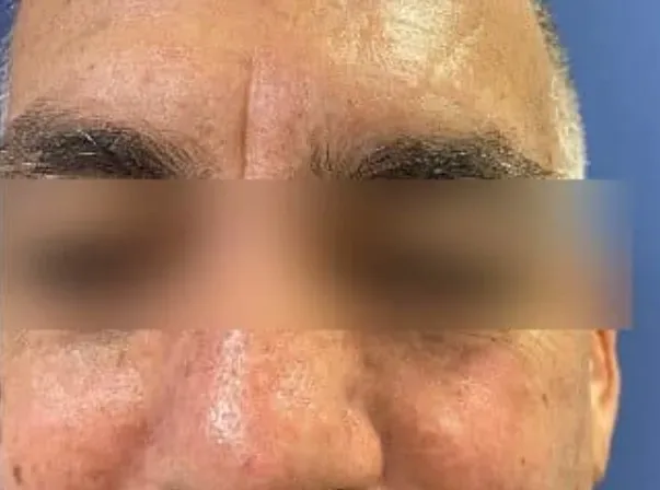 הסרת שומה בפנים בלייזר