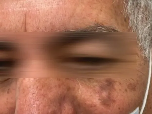 הסרת שומות בלייזר